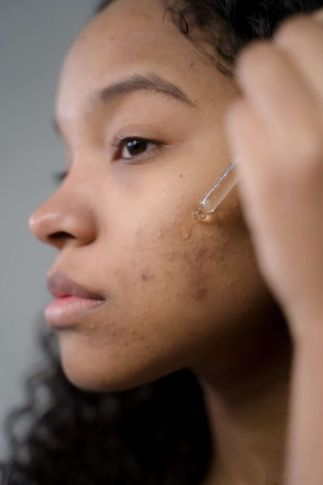 Poussée de boutons après soleil : une femme effectuant un soin sur les zones acnéique