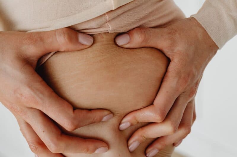 démangeaison après accouchement : une femme montre ses vergetures