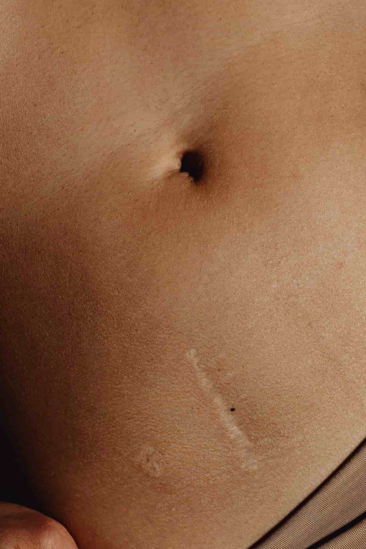 cicatrices cesarienne : une femme ayant une cicatrice du à la césarienne