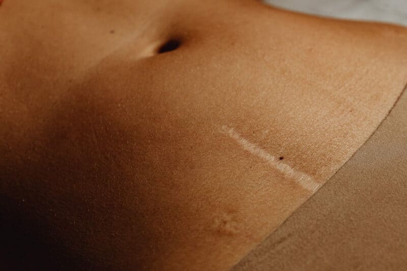 cicatrices cesarienne : une cicatrice de césarienne sur une femme
