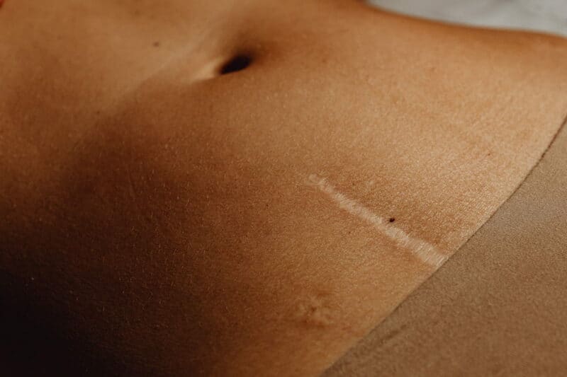 cicatrices cesarienne : une cicatrice de césarienne sur une femme